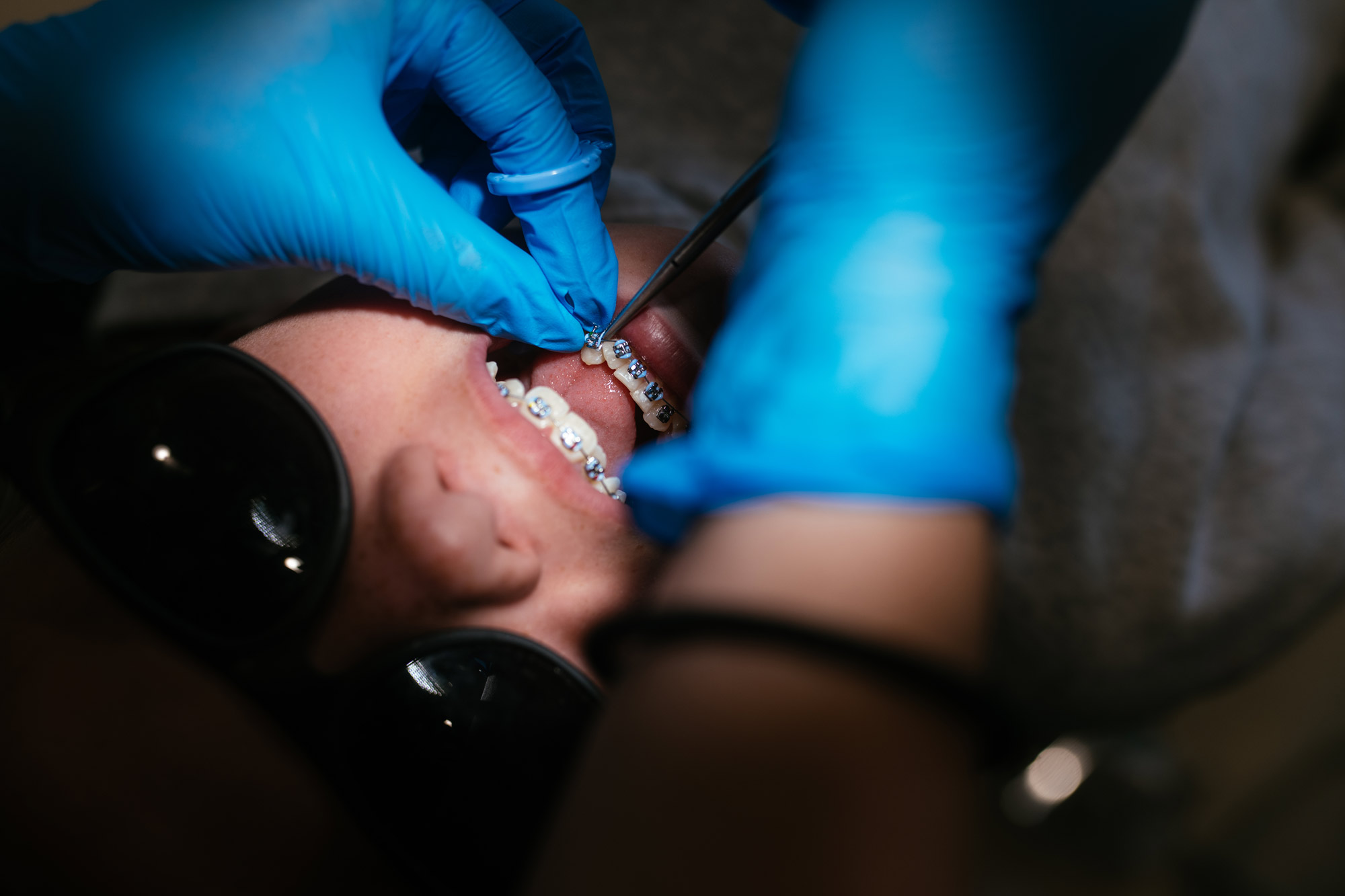 Orthodontic team member in blue gloves adjusting a patient's braces during a treatment visit at Haverkos Family Orthodontics in Cincinnati