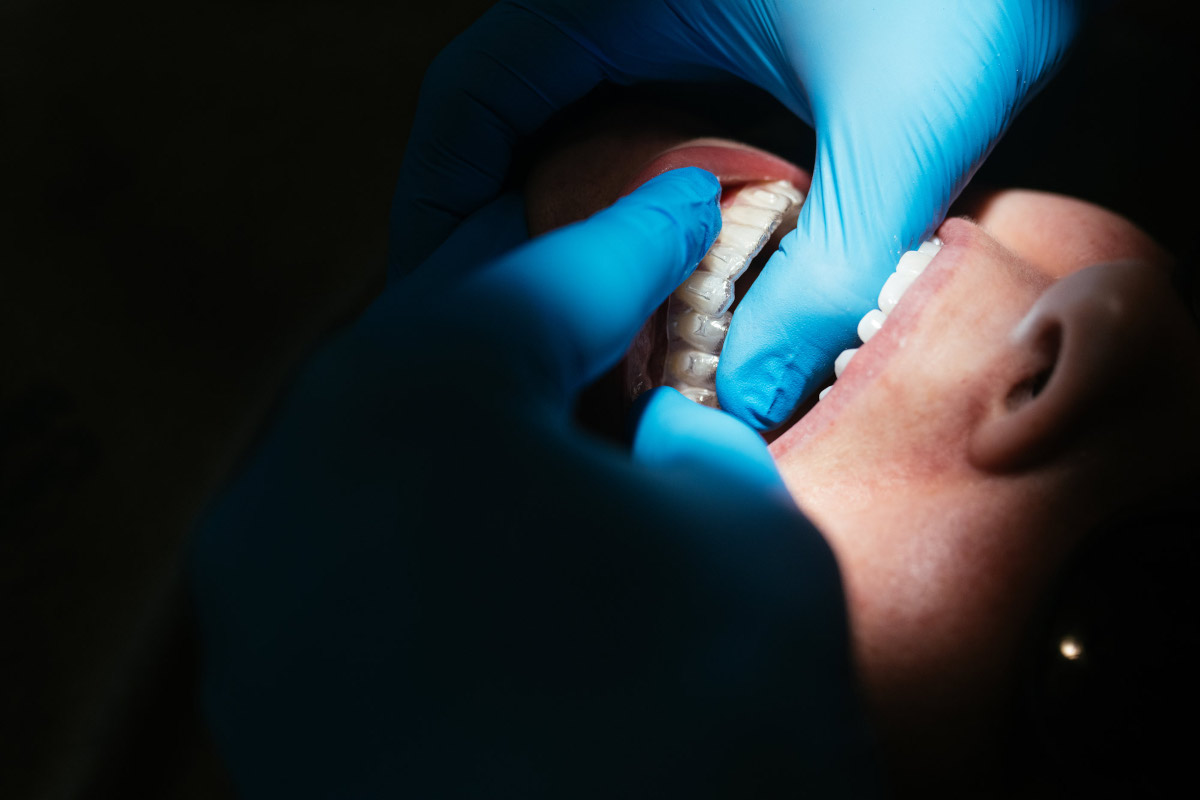 Clear aligner tray being fitted onto a patient's lower teeth at Haverkos Family Orthodontics in Harrison, OH.