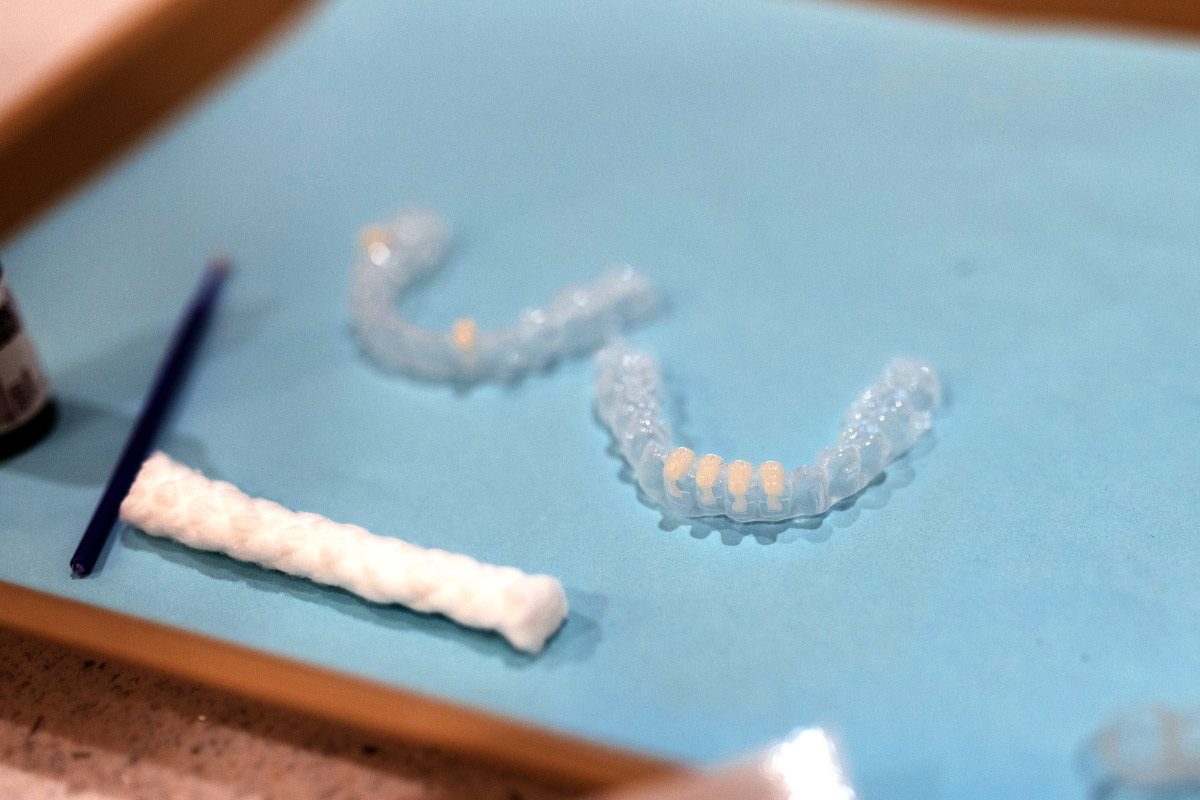 Indirect bonding tray with pre-loaded aligner attachments ready to bond to teeth at Haverkos Family Orthodontics in Harrison, OH.