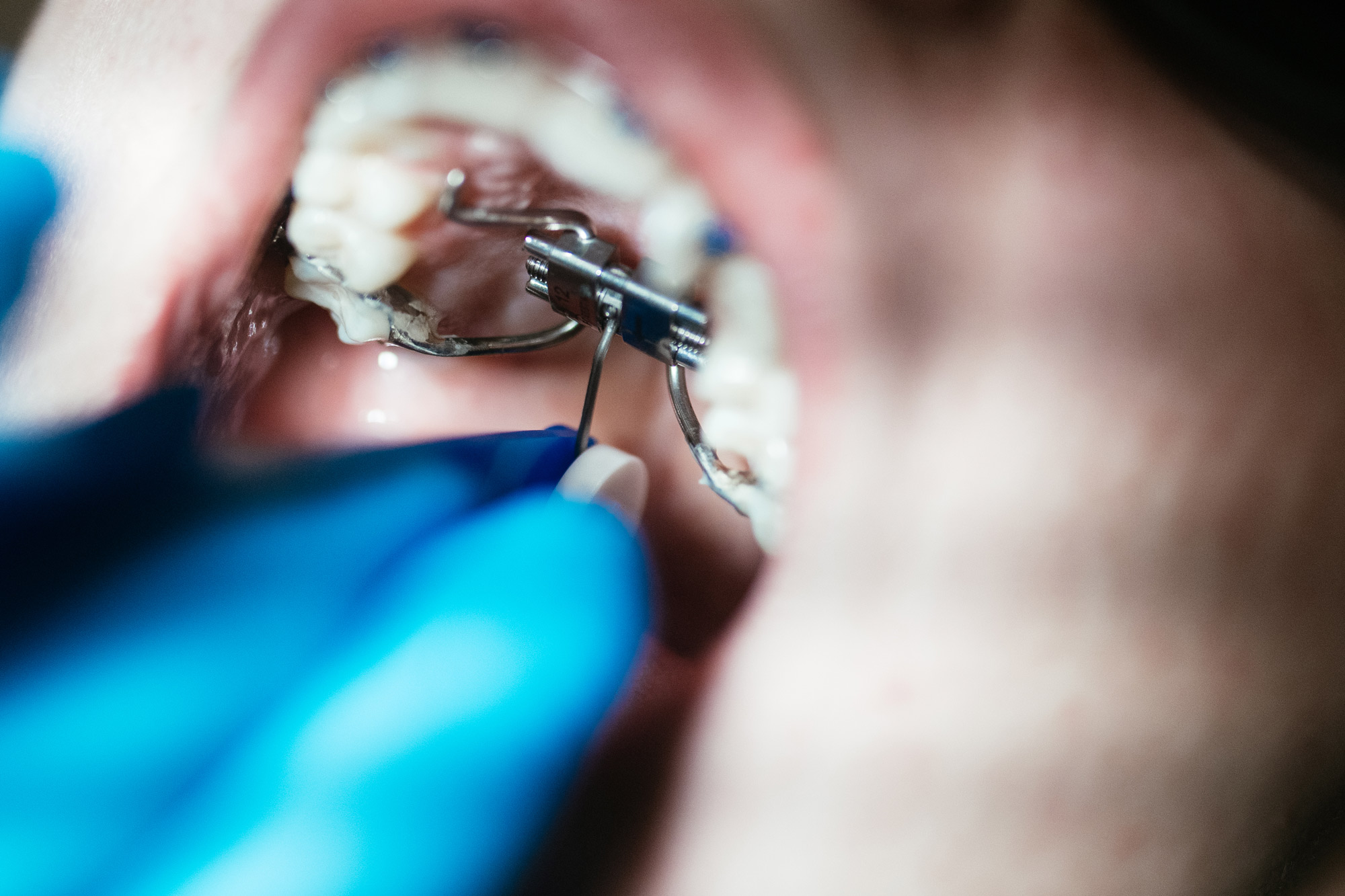 Orthodontist adjusting a palate expander with a key tool during airway orthodontics treatment at Haverkos Family Orthodontics in Cincinnati