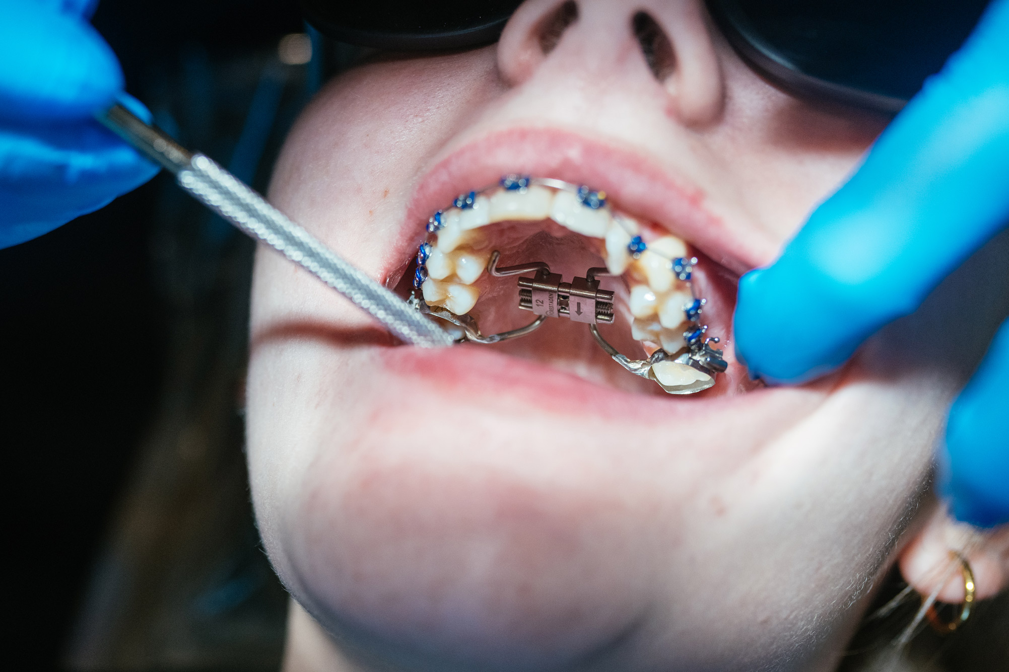 Palate expander adjustment for airway orthodontics treatment at a Cincinnati orthodontic office